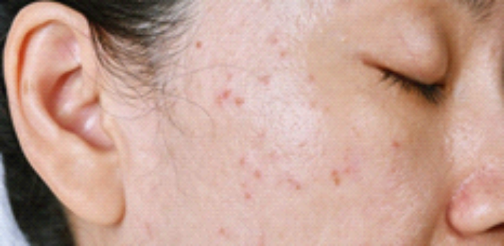 Gambar Kulit Berminyak Hingga Berjerawat