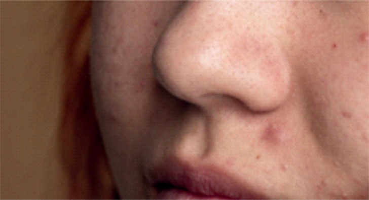 Gambar Kulit Berminyak Hingga Berjerawat